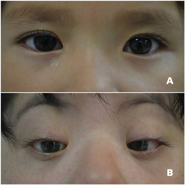 A, Epicanto tarsal. B, Epicanto inverso, note cómo el pliegue cutáneo inicia en el párpado inferior y se extiende por arriba del canto medial.