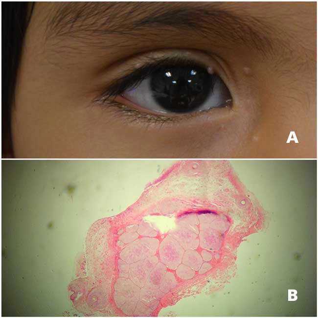 A, El paciente presenta múltiples lesiones nodulares blanquecinas compatibles con molusco contagioso. B, Se observa un corte histológico que demuestra los cuerpos de Henderson-Paterson, también llamados cuerpos de molusco.